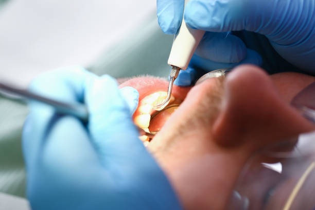 Best Emergency Dentist for Lost Fillings or Crowns in March Ar, CA