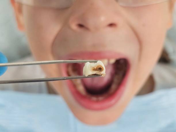 Best Broken or Cracked Tooth Emergency Dentist in March Ar, CA