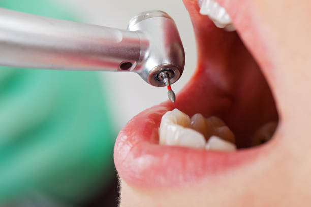 Best Emergency Dentist for Knocked-Out Tooth in March Ar, CA